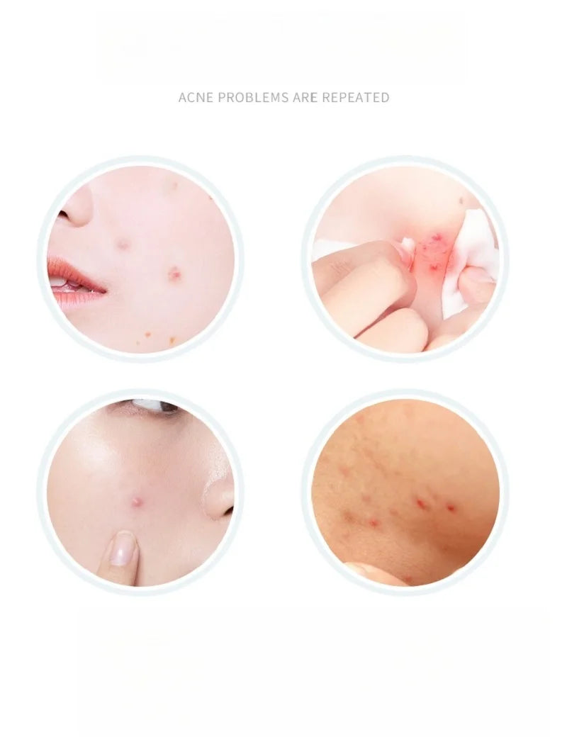 Wasserdichte hydrokolloide Akne Patches zur Hautpflege und Mitesserentfernung