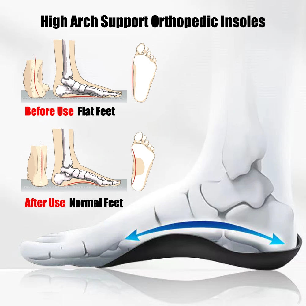 Einlegesohlen für Plantarfasziitis, Plattfüße & XO-Beine Korrektur